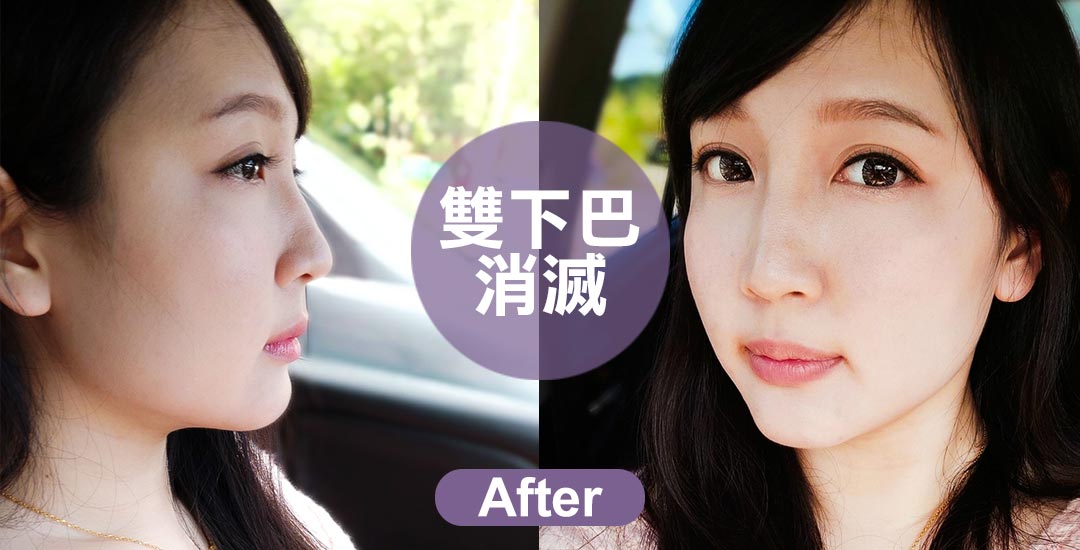 擺脫雙下巴。擁有迷人下顎線條