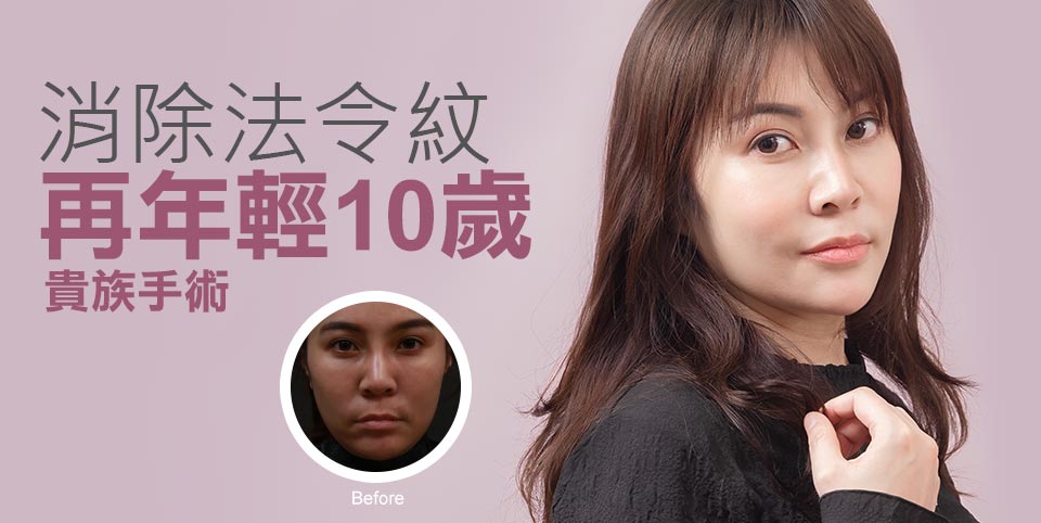 貴族手術消除法令紋 讓自己再年輕10歲