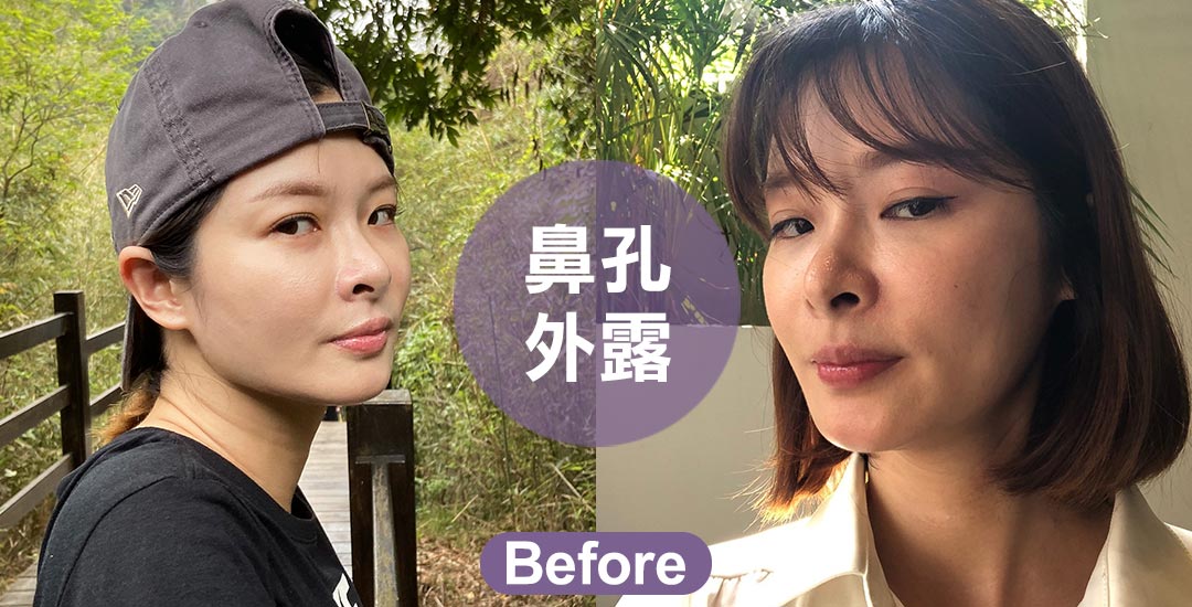 打造完美鼻形-隆鼻手術