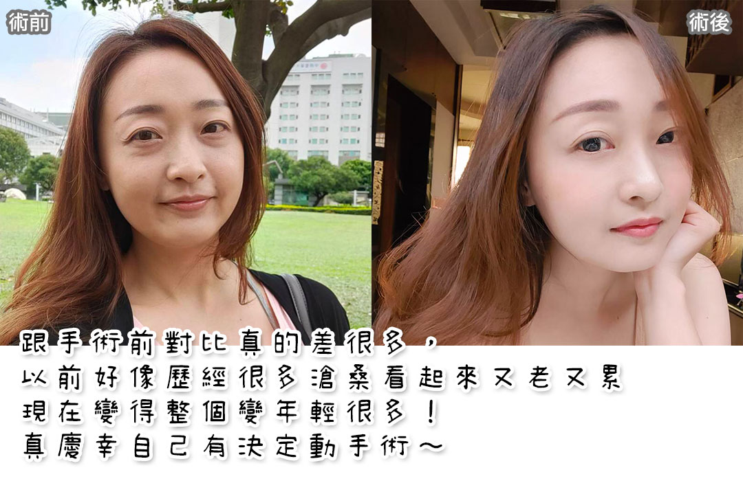林永祥醫師眼袋手術案例術後-03