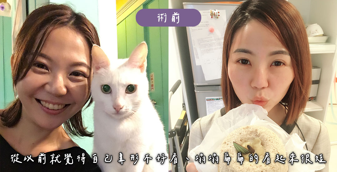 隆鼻/臉部精雕手術打造混血臉龐心得分享