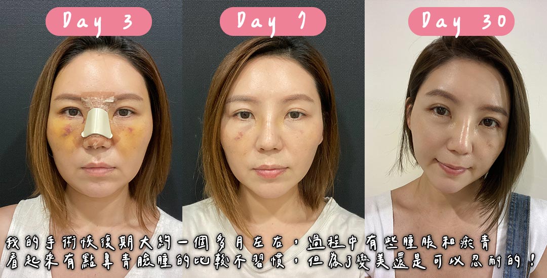 隆鼻/臉部精雕手術打造混血臉龐心得分享