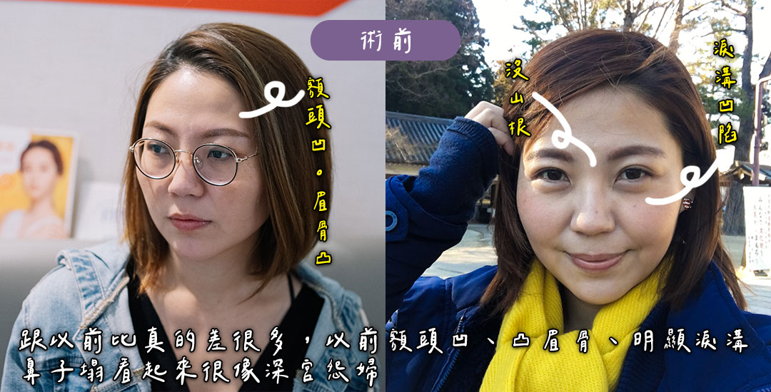 隆鼻/臉部精雕手術打造混血臉龐心得分享