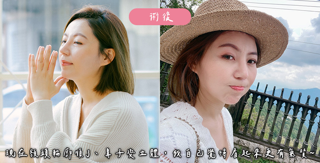 隆鼻/臉部精雕手術打造混血臉龐心得分享