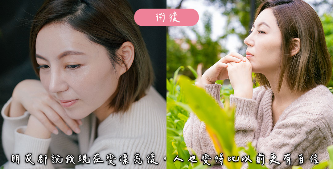 隆鼻/臉部精雕手術打造混血臉龐心得分享