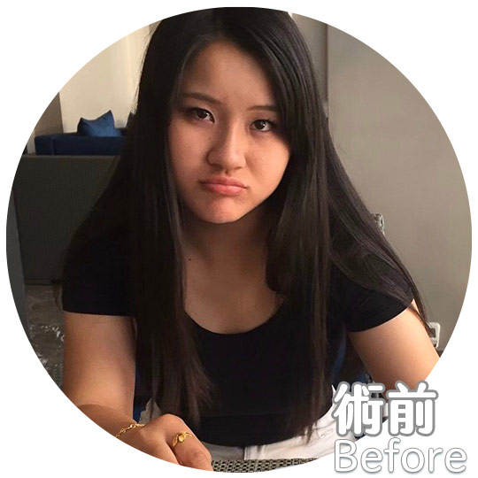 口內取脂/鼻溝槽(鼻基底)手術瘦出完美臉蛋心得分享