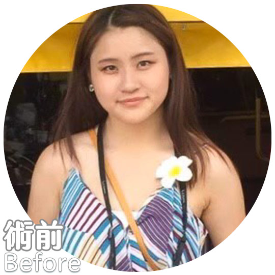 口內取脂/鼻溝槽(鼻基底)手術瘦出完美臉蛋心得分享