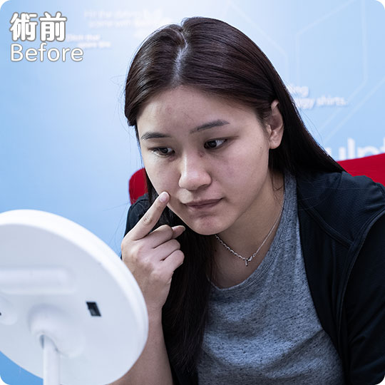口內取脂/鼻溝槽(鼻基底)手術瘦出完美臉蛋心得分享