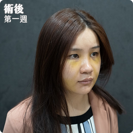 口內取脂/鼻溝槽(鼻基底)手術瘦出完美臉蛋心得分享
