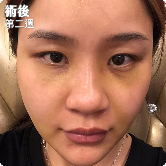 口內取脂/鼻溝槽(鼻基底)手術瘦出完美臉蛋心得分享
