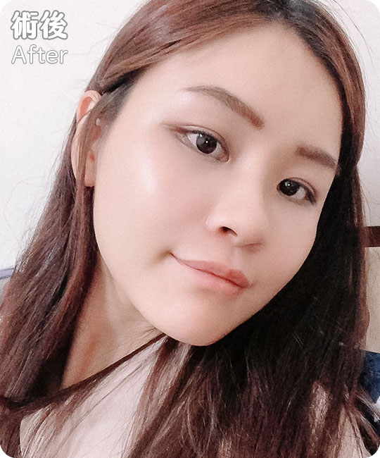 口內取脂/鼻溝槽(鼻基底)手術瘦出完美臉蛋心得分享