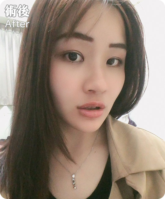 口內取脂/鼻溝槽(鼻基底)手術瘦出完美臉蛋心得分享