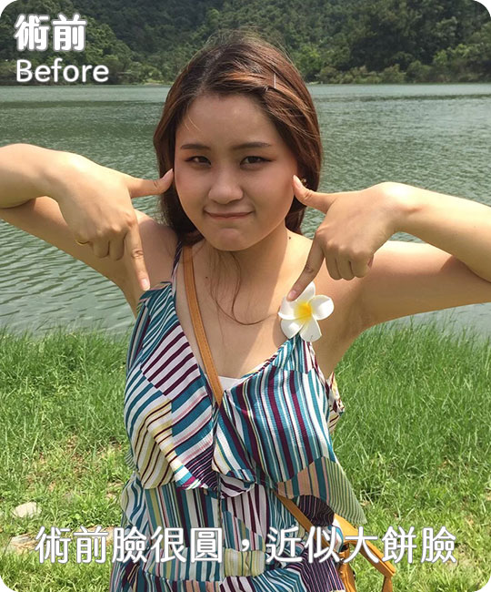 口內取脂,消除嬰兒肥臉型|重回V字臉