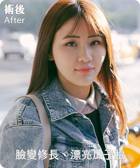 口內取脂,消除嬰兒肥臉型|重回V字臉