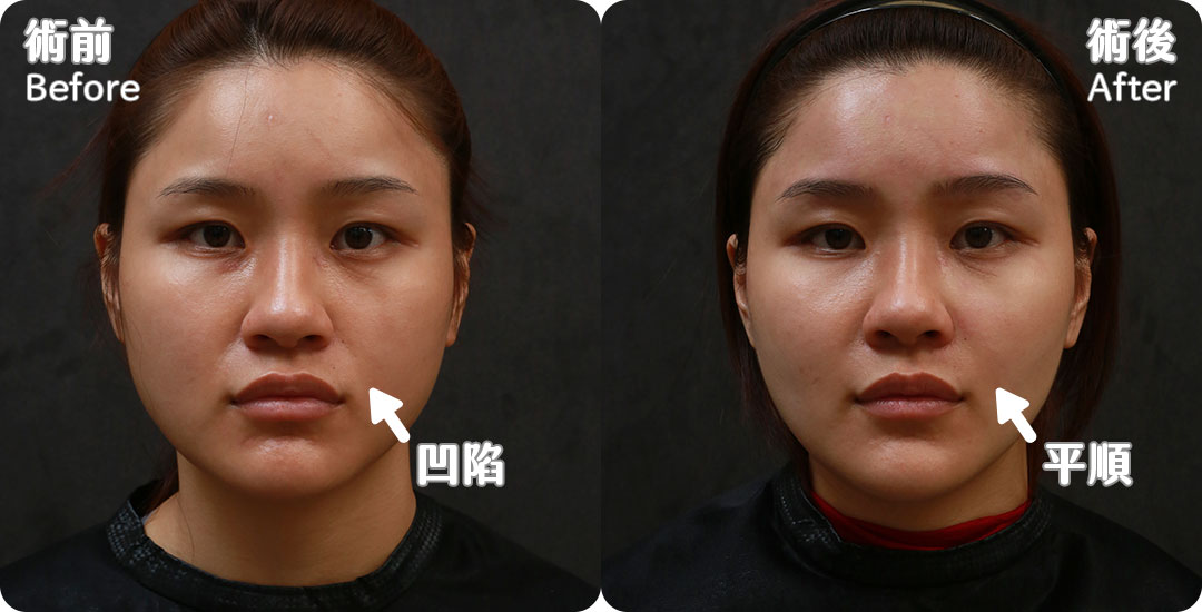 口內取脂/鼻溝槽(鼻基底)手術瘦出完美臉蛋心得分享