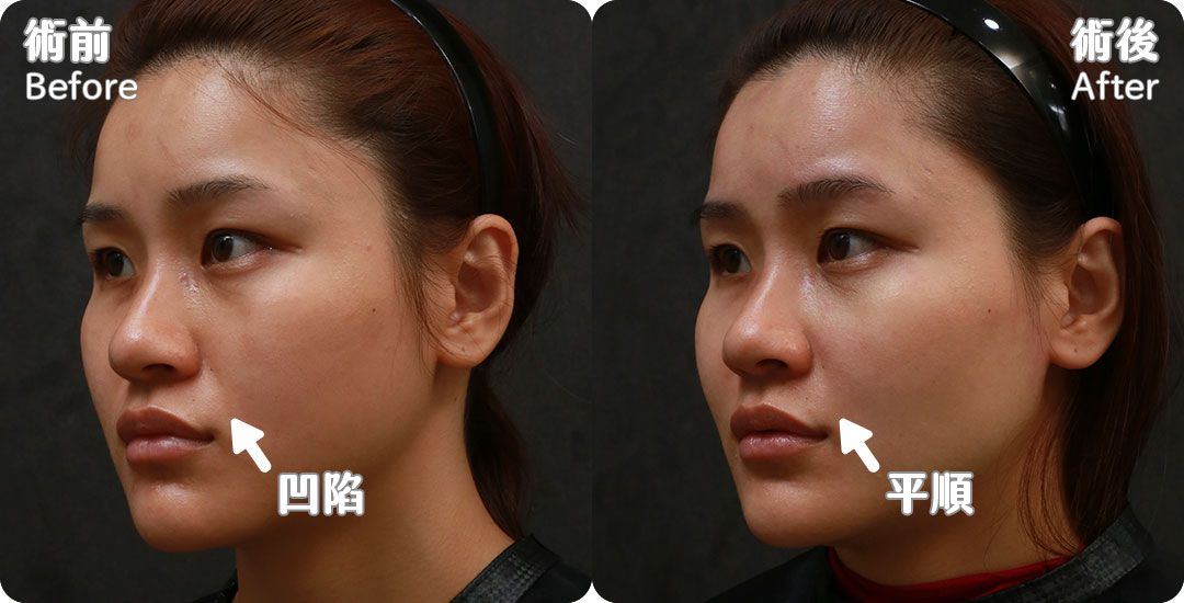 口內取脂/鼻溝槽(鼻基底)手術瘦出完美臉蛋心得分享