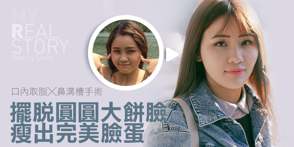 口內取脂/鼻溝槽(鼻基底)手術瘦出完美臉蛋心得分享