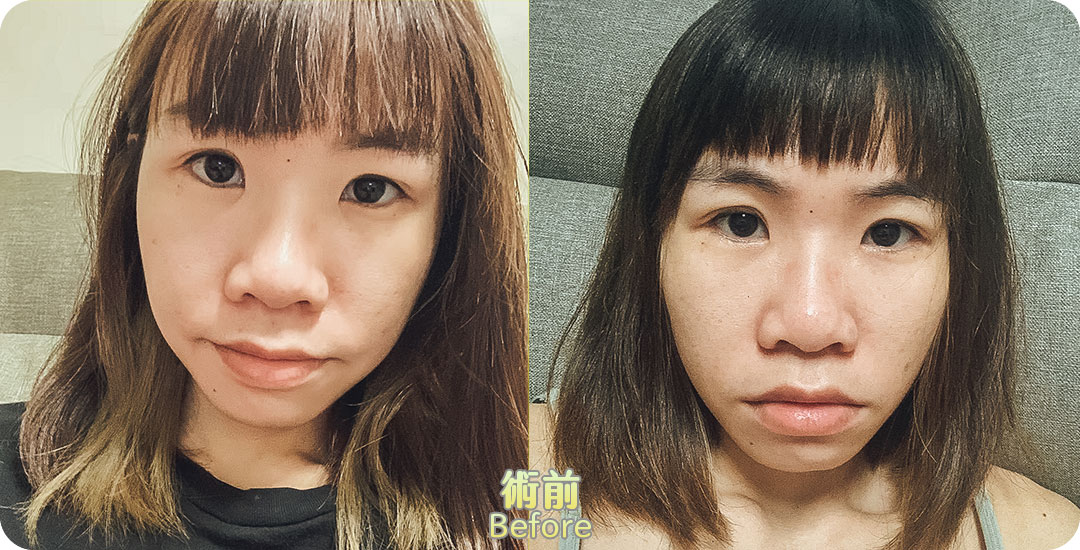 雙眼皮+開眼頭|桃花電眼|魅瞳電眼|精緻深邃