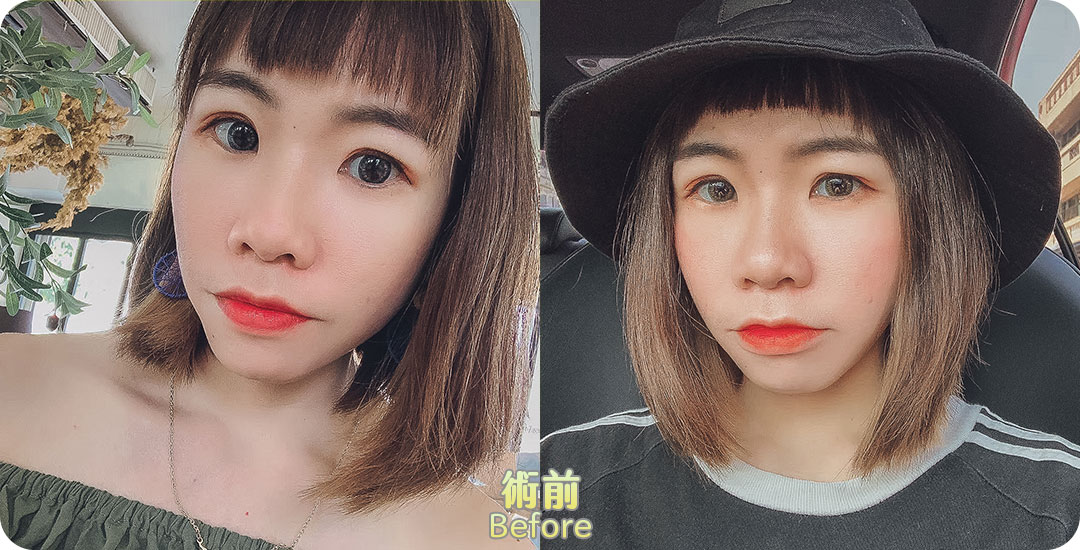 雙眼皮+開眼頭|桃花電眼|魅瞳電眼|精緻深邃