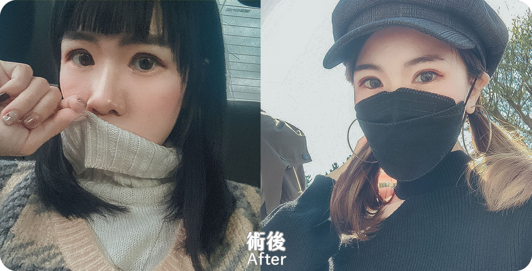 雙眼皮+開眼頭|桃花電眼|魅瞳電眼|精緻深邃