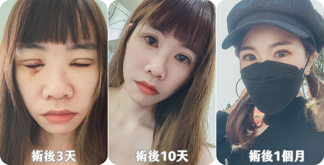 雙眼皮+開眼頭|桃花電眼|魅瞳電眼|精緻深邃