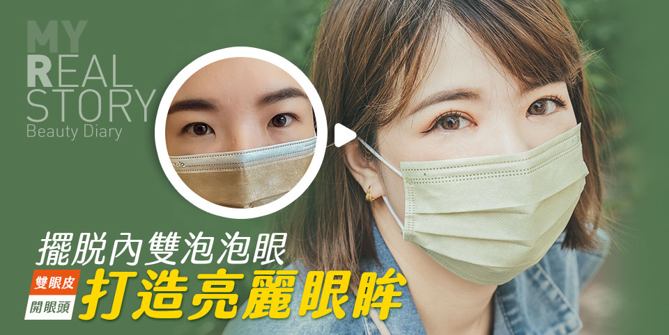 開眼頭+雙眼皮手術術後心得分享