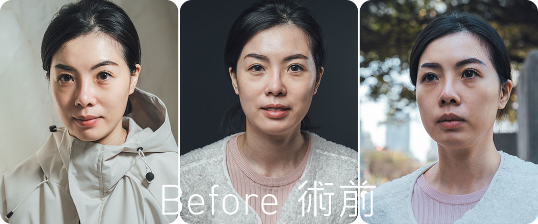 台中隱痕眼袋手術心得分享|眼袋內開手術心得分享紀錄