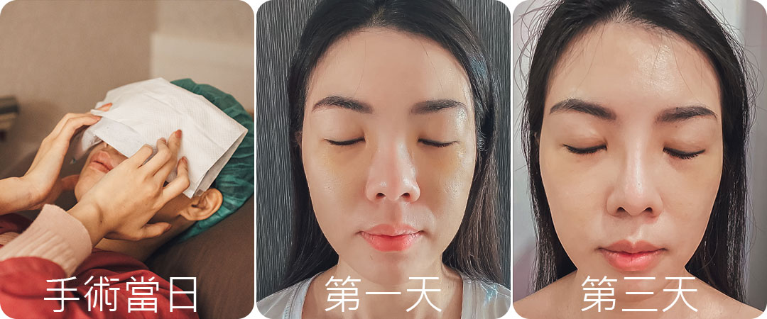 台中隱痕眼袋手術心得分享|眼袋內開手術心得分享紀錄