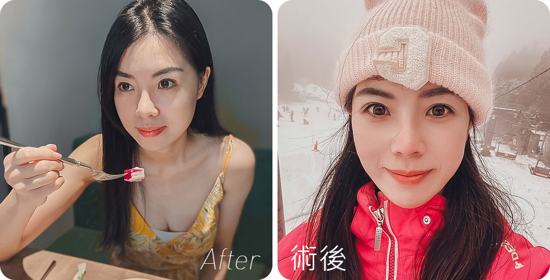 台中隱痕眼袋手術心得分享|眼袋內開手術心得分享紀錄