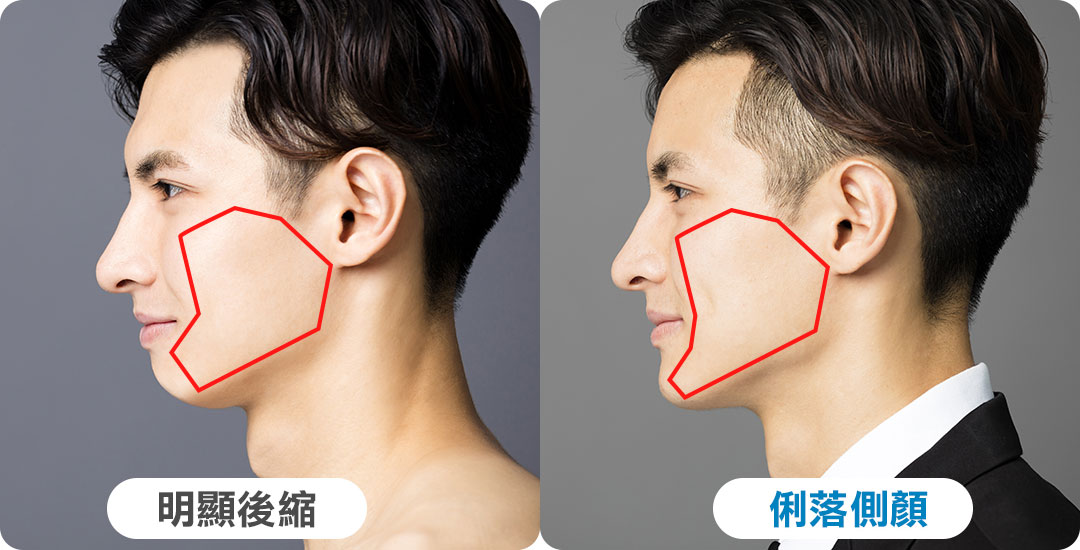 下巴後縮最苦惱的「側臉」
