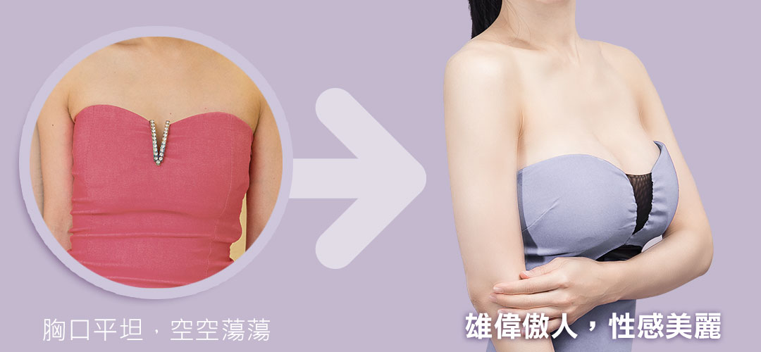 隆乳案例比對|性感美麗