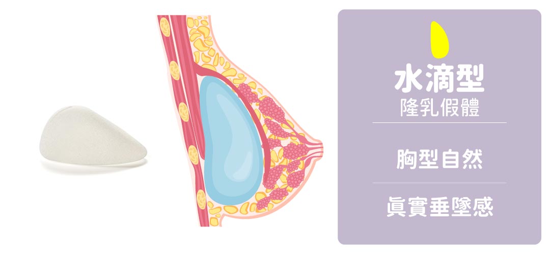 隆乳假體形狀|水滴型隆乳假體 隆乳假體形狀|水滴型隆乳假體