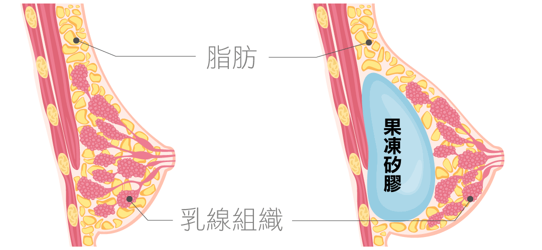 隆乳假體形狀|水滴型隆乳假體 隆乳假體形狀|水滴型隆乳假體