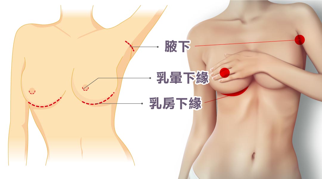 隆乳手術切口|乳暈下緣|乳房下緣|腋下 隆乳手術切口|乳暈下緣|乳房下緣|腋下