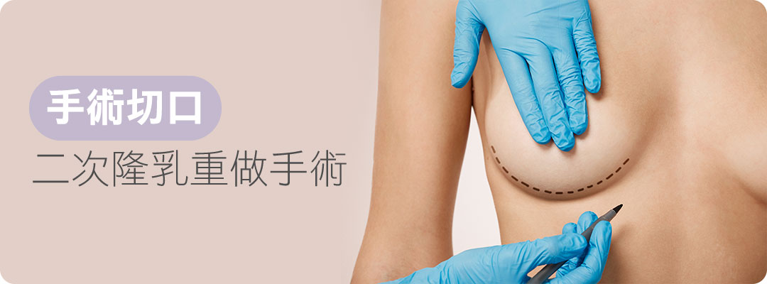 二次隆乳手術疤痕|隆乳後悔手術切口位置 二次隆乳手術疤痕|隆乳後悔手術切口位置