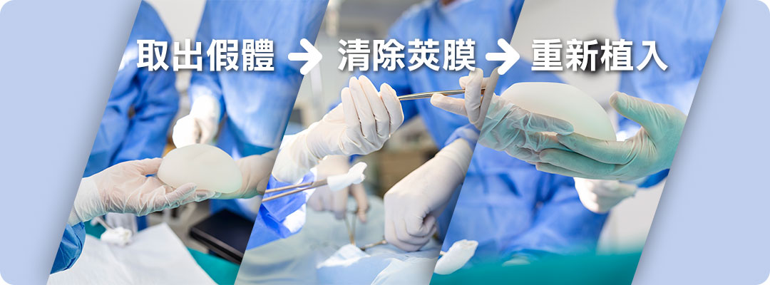 二次隆乳手術疤痕|二次隆乳手術方式 二次隆乳手術疤痕|二次隆乳手術方式