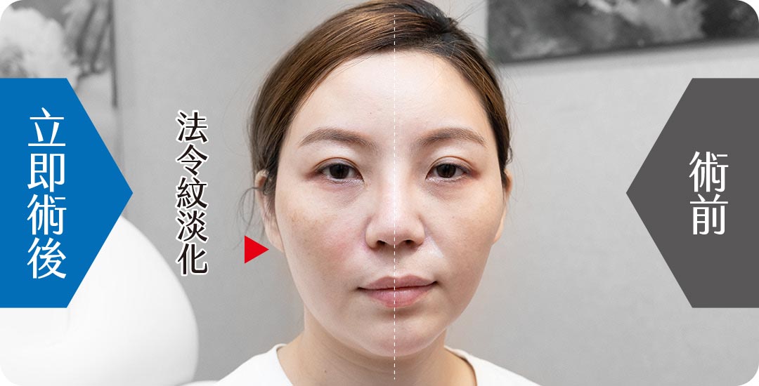 洢蓮絲淚溝Ellanse，讓妳的臉型更精緻，改善臉部老態