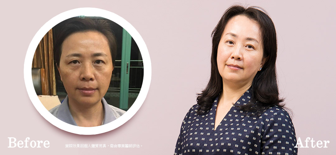 微創五爪八爪前額內視鏡拉皮手術