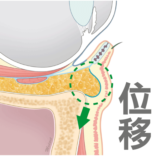 台中眼袋手術推薦|消除眼袋手術方式|眼袋手術費用|脂肪位移術