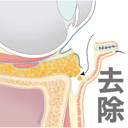 台中眼袋手術推薦|消除眼袋手術方式|眼袋手術費用|脂肪位移術