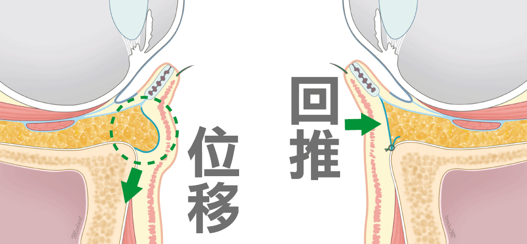 台中眼袋手術推薦|消除眼袋手術方式|眼袋手術費用|脂肪位移術