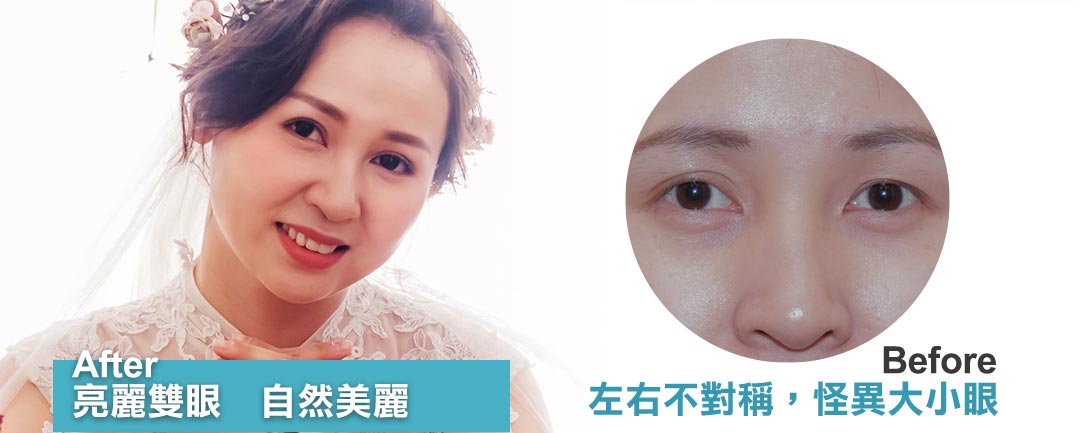 台中雙眼皮推薦。隱痕縫雙眼皮首選