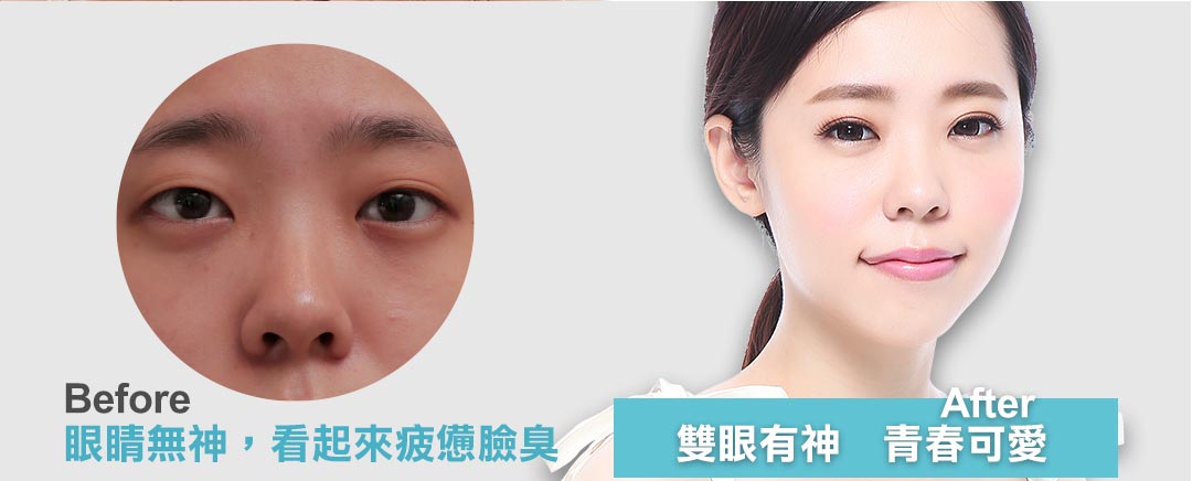 台中雙眼皮推薦。隱痕縫雙眼皮首選