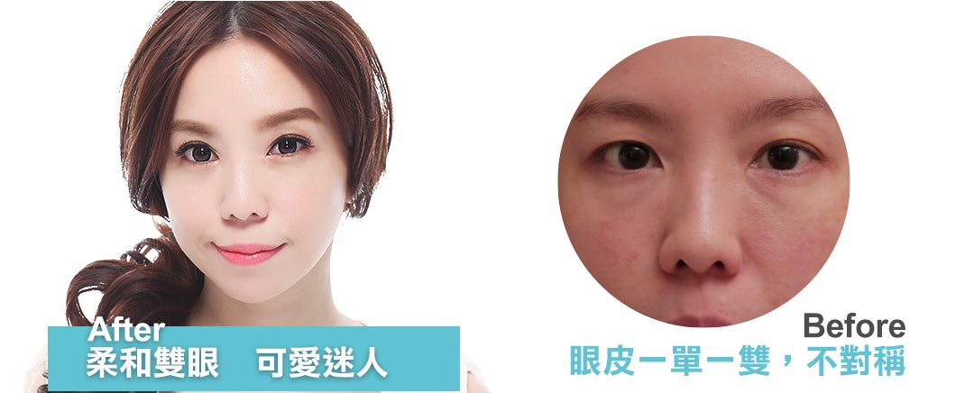 台中雙眼皮推薦。隱痕縫雙眼皮首選