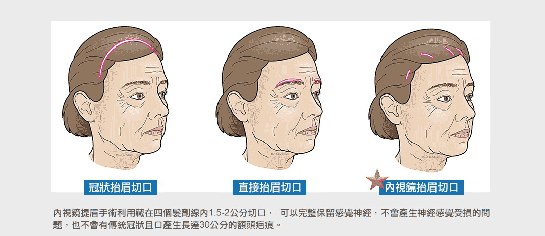 隱痕提眉手術-內視鏡提眉手術方法