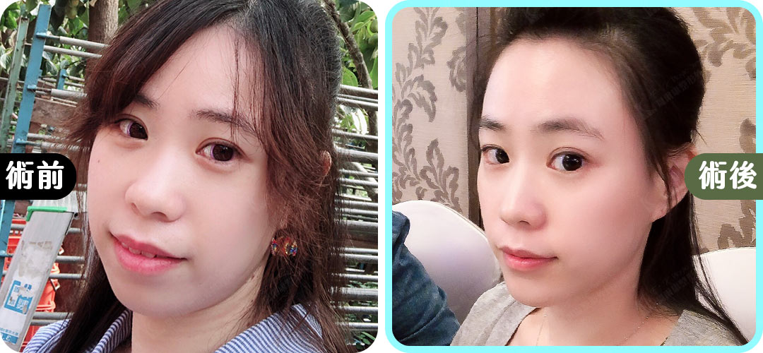 口內取脂,消除嬰兒肥臉型|重回V字臉