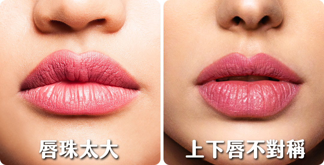 唇型手術介紹