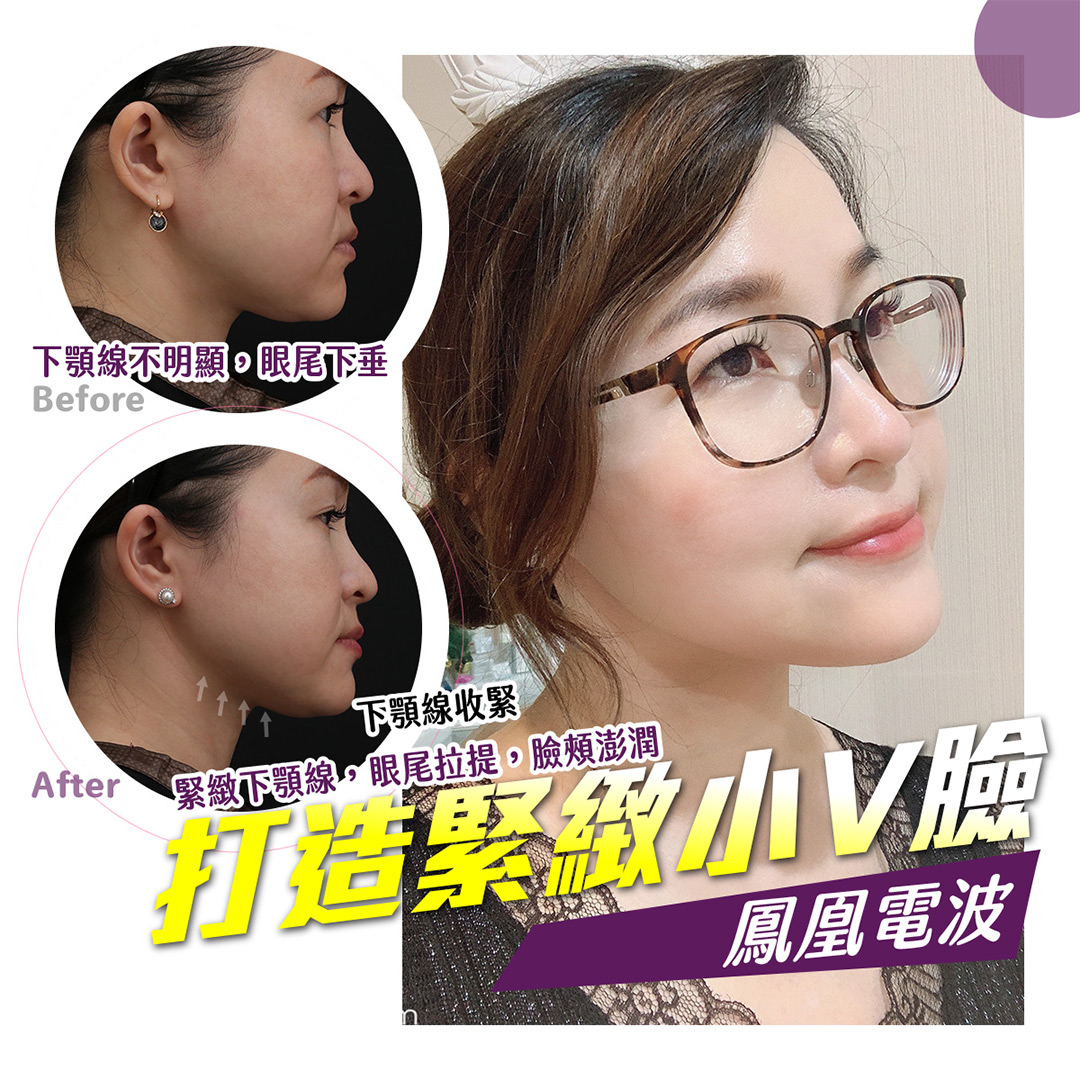 鳳凰電波拉提療程拉提肌膚鬆弛,打造緊緻輪廓