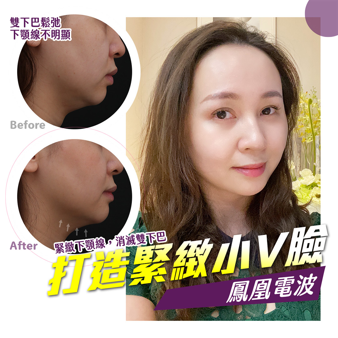 鳳凰電波拉提療程拉提肌膚鬆弛,打造緊緻小V臉