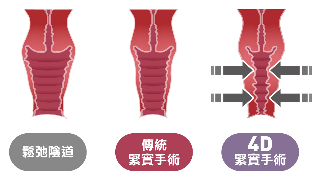 閨密女醫黃馨慧醫師陰道鬆弛的原因